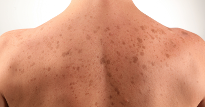 sun-spots-on-skin