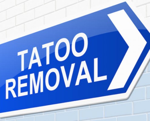 Tatoo-removal-cream