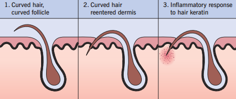 Ingrown-hair