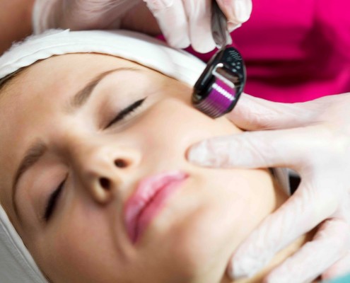 micro-needling-treatment