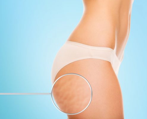 best-cellulite-treatments