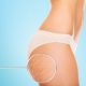 best-cellulite-treatments