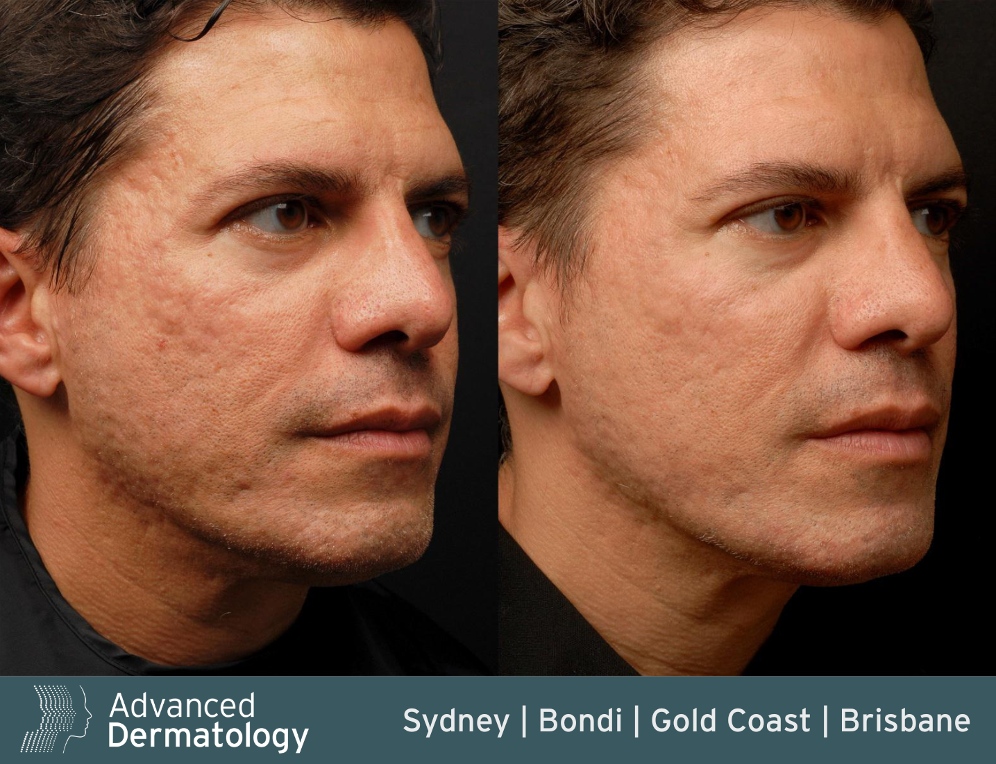RF microneedling before after