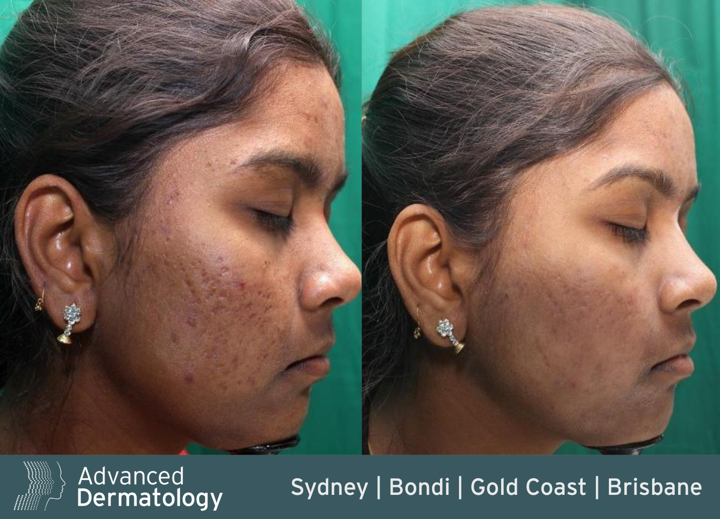 RF microneedling before after