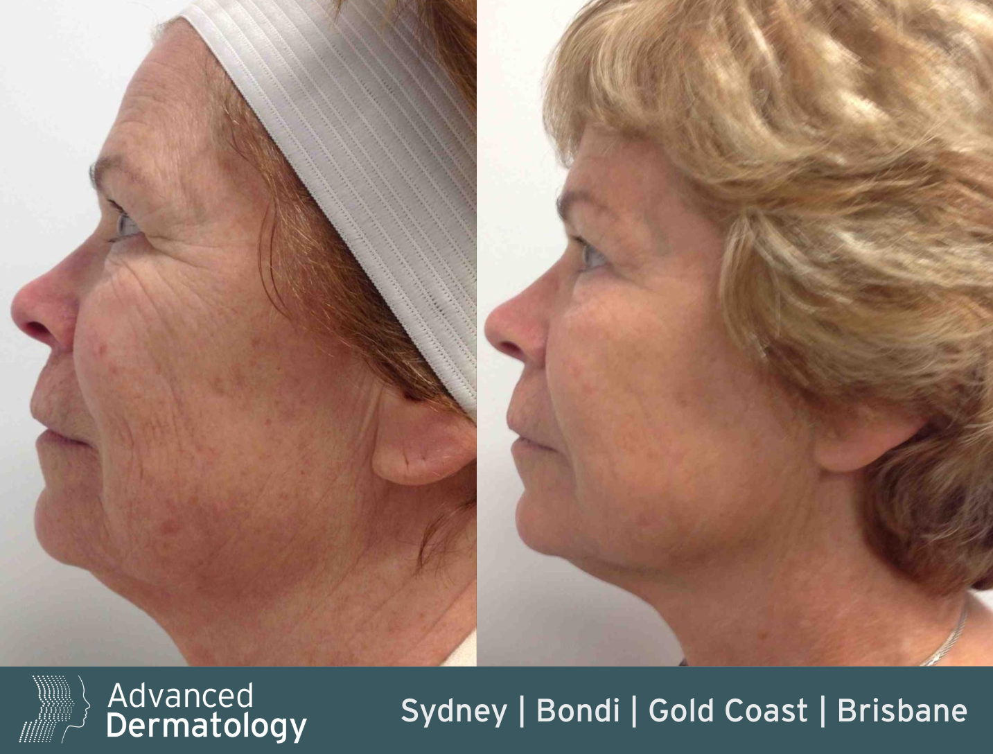 RF microneedling before after